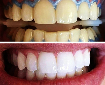 Antes e Depois Clareamento Dental