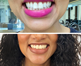 Antes e Depois Clareamento Dental