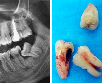 Antes e Depois Dente do Siso