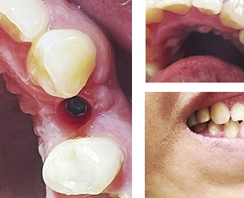 Antes e Depois Implante Dental