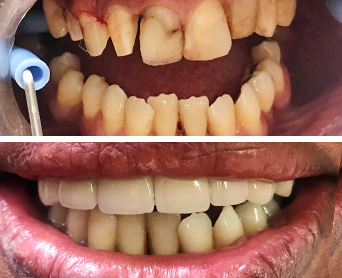 Antes e Depois Implante Dental