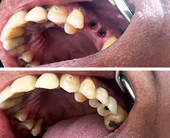 Antes e Depois Implante Dental