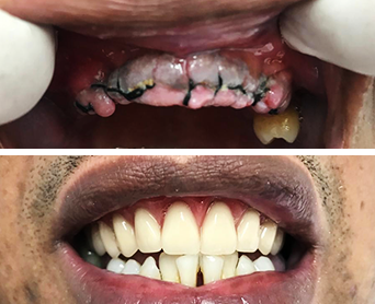 Antes e Depois Implante Dental