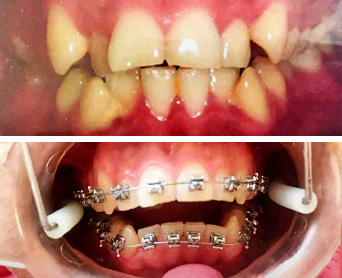 Antes e Depois Ortodontia (Aparelho Dental)