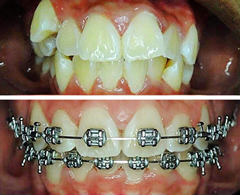 Antes e Depois Ortodontia (Aparelho Dental)